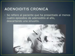 • Se refiere al paciente que ha presentado al menos
  cuatro episodios de adenoiditis al año,
  descartando una sinusitis.
 