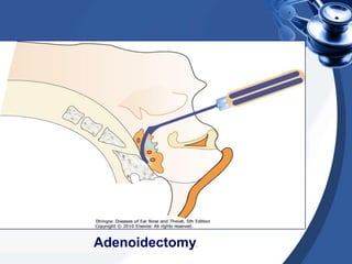 Adenoidectomy.
 