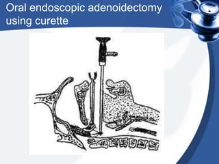 Oral endoscopic adenoidectomy
using curette
 