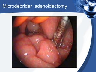 Microdebrider adenoidectomy
 