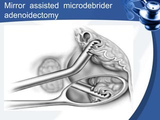 Mirror assisted microdebrider
adenoidectomy
 
