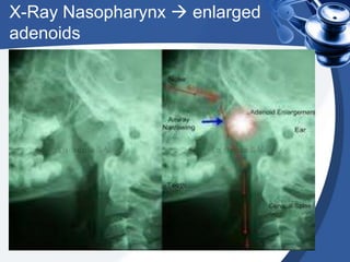 X-Ray Nasopharynx  enlarged
adenoids
 