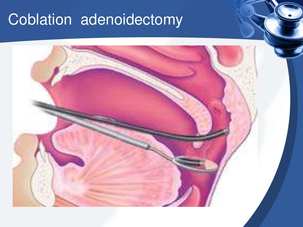 Adenoids