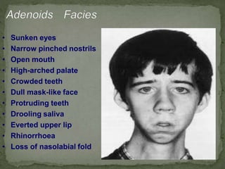 • Sunken eyes
• Narrow pinched nostrils
• Open mouth
• High-arched palate
• Crowded teeth
• Dull mask-like face
• Protruding teeth
• Drooling saliva
• Everted upper lip
• Rhinorrhoea
• Loss of nasolabial fold
 