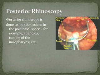 •Posterior rhinoscopy is
done to look for lesions in
the post nasal space – for
example, adenoids,
tumors of the
nasopharynx, etc.
 