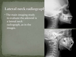 • The main imaging study
to evaluate the adenoid is
a lateral neck
radiograph, as in the
images.
 