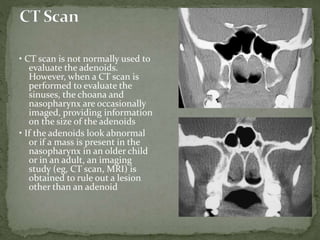 • CT scan is not normally used to
evaluate the adenoids.
However, when a CT scan is
performed to evaluate the
sinuses, the choana and
nasopharynx are occasionally
imaged, providing information
on the size of the adenoids
• If the adenoids look abnormal
or if a mass is present in the
nasopharynx in an older child
or in an adult, an imaging
study (eg, CT scan, MRI) is
obtained to rule out a lesion
other than an adenoid
 