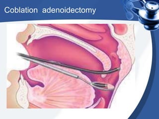 Coblation adenoidectomy
 