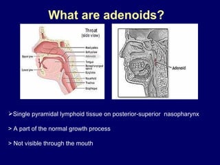 What are adenoids?   ,[object Object]