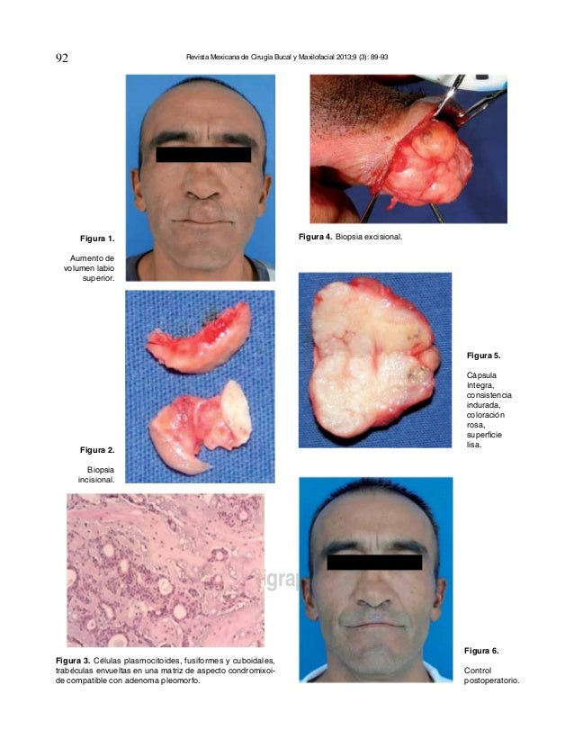 Adenoma pleomorfo en el labio superior hospital juarez