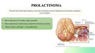 PROLACTINOMA
Tumores de células lacto trópicas, cerca de la mitad de tumores hipofisarios funcionales, prevalece
en las mujeres
• Micro adenomas no invaden región parasillar
• Macro adenomas invasión local, comprimir estructuras vecinas.
• Valores mayor a 250 ug/L --macroadenomas
 
