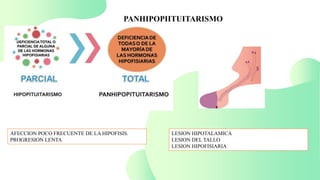 PANHIPOPIITUITARISMO
AFECCION POCO FRECUENTE DE LA HIPOFISIS.
PROGRESION LENTA
LESION HIPOTALAMICA
LESION DEL TALLO
LESION HIPOFISIARIA
 