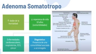 Adenoma Somatotropo
 