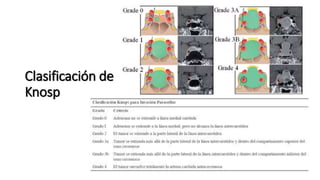 Clasificación de
Knosp
 