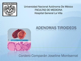 ADENOMAS TIROIDEOS
Cordero Comparán Joseline Montserrat
Universidad Nacional Autónoma De México
FACULTAD DE MEDICINA
Hospital General La Villa
 