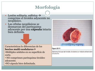 Morfología
 Lesión solitaria, esférica 
comprime el tiroides adyacente no
neoplásico.
 Las células neoplásicas se
desmarcan del parénquima
adyacente por una cápsula intacta
bien definida.
Características lo diferencian de los
bocios multi-nodulares
•Múltiples nódulos en su superficie de
corte.
• NO comprimen parénquima tiroideo
adyacente.
•NO cápsula bien delimitada.
 