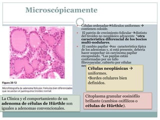 Microscópicamente
 Células ordenadasfolículos uniformes 
contienen coloide.
 El patrón de crecimiento folicular distinto
del tiroides no neoplásico adyacente *otra
característica diferencial de los bocios
multi-nodulares.
 El cambio papilar no característica típica
de los adenomas y, si está presente, debería
hacer sospechar un carcinoma papilar
encapsulado. *Las papilas están
conformadas por un tallo
fibrovascular, cubierto por células
neoplásicas.
Citoplasma granular eosinófilo
brillante (cambios oxifilicos o
células de Hürthle).
La Clínica y el comportamiento de un
adenoma de células de Hürthle son
iguales a adenomas convencionales.
Células neoplásicas 
uniformes.
•Bordes celulares bien
definidos.
 