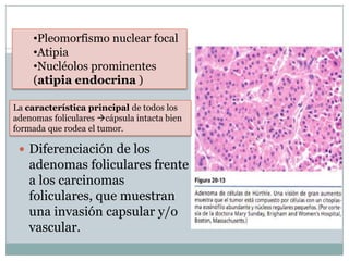  Diferenciación de los
adenomas foliculares frente
a los carcinomas
foliculares, que muestran
una invasión capsular y/o
vascular.
•Pleomorfismo nuclear focal
•Atipia
•Nucléolos prominentes
(atipia endocrina )
La característica principal de todos los
adenomas foliculares cápsula intacta bien
formada que rodea el tumor.
 