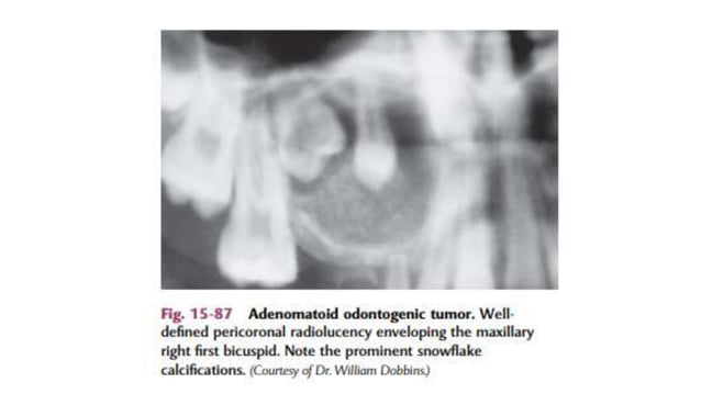 adenomatoid-odontogenic-tumor-pptx