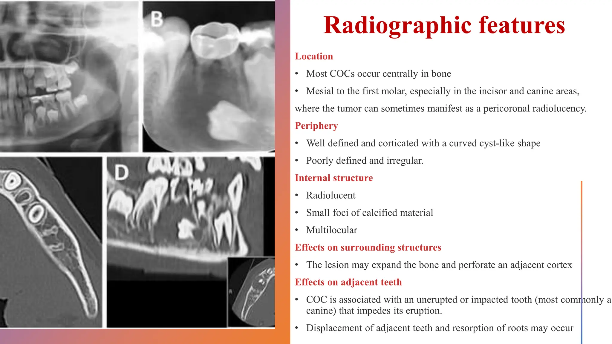Adenomatoid odontogenic tumor, calcifying epithelial odontogenic tumors ...