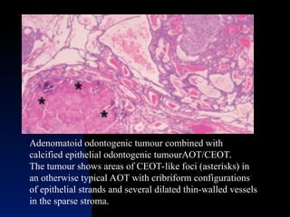 Aot Radiograph Comprehensive Overview of Adenomatoid Odontogenic Tumour: Clinical ...