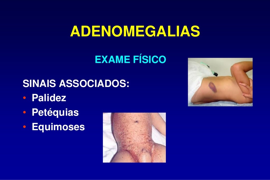 O Que é Adenomegalias - RETOEDU