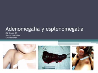 Adenomegalia y esplenomegalia 
IPC Grupo 32 
Andres Gonzalez 
Larisa Loaiza 
 