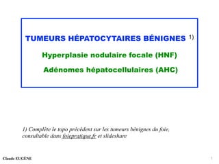 TUMEURS HÉPATOCYTAIRES BÉNIGNES 1)
Hyperplasie nodulaire focale (HNF)
Adénomes hépatocellulaires (AHC)
1) Complète le topo précédent sur les tumeurs bénignes du foie,
consultable dans foiepratique.fr et slideshare
Claude EUGÈNE 1
 