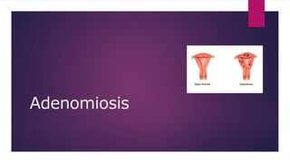 Adenomiosis
 