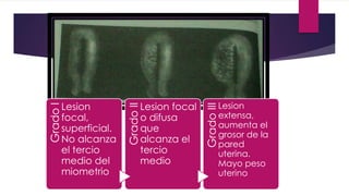GradoI
Lesion
focal,
superficial.
No alcanza
el tercio
medio del
miometrio
GradoII
Lesion focal
o difusa
que
alcanza el
tercio
medio
GradoIII
Lesion
extensa,
aumenta el
grosor de la
pared
uterina.
Mayo peso
uterino
 
