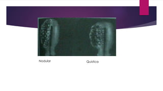 Nodular Quistica
 