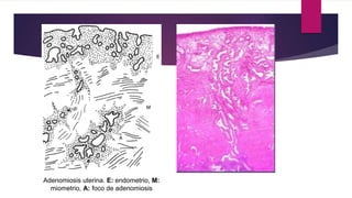 Adenomiosis uterina. E: endometrio, M:
miometrio, A: foco de adenomiosis
 