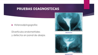 PRUEBAS DIAGNOSTICAS
 Histerosalpingografia:
Divertículos endometriales
y defectos en panal de abejas
 