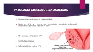 PATOLOGIA GINECOLOGICA ASOCIADA
 Rara vez se presenta como un hallazgo aislado
 Hasta un 80% se asocia con: miomatosis, hiperplasia endometrial,
endometriosis peritoneal y cáncer de útero
 Mas asociado a miomatosis 50%
 Similitud de síntomas
 Salpingitis ístmica nodosa 10%
 
