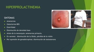 HIPERPROLACTINEMIA

SINTOMAS
   Amenorrea
   Galactorrea 80%
   Esterilidad
   Disminución de densidad ósea
   Antes de la menarquia: amenorrea primaria.
   En varones: disminución de la líbido, pérdida de la visión.
   Por supresión de gonadotropinas: disminución de testosterona
 