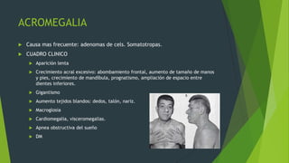 ACROMEGALIA
   Causa mas frecuente: adenomas de cels. Somatotropas.
   CUADRO CLINICO
        Aparición lenta
        Crecimiento acral excesivo: abombamiento frontal, aumento de tamaño de manos
         y pies, crecimiento de mandíbula, prognatismo, ampliación de espacio entre
         dientes inferiores.
        Gigantismo
        Aumento tejidos blandos: dedos, talón, nariz.
        Macroglosia
        Cardiomegalia, visceromegalias.
        Apnea obstructiva del sueño
        DM
 