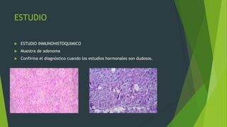 ESTUDIO

   ESTUDIO INMUNOHISTOQUIMICO
   Muestra de adenoma
   Confirma el diagnóstico cuando los estudios hormonales son dudosos.
 