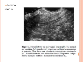  Normal
uterus
 