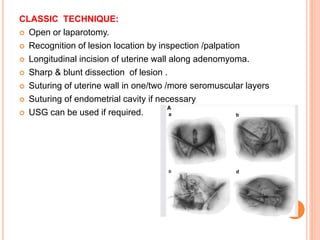 CLASSIC TECHNIQUE:
 Open or laparotomy.
 Recognition of lesion location by inspection /palpation
 Longitudinal incision of uterine wall along adenomyoma.
 Sharp & blunt dissection of lesion .
 Suturing of uterine wall in one/two /more seromuscular layers
 Suturing of endometrial cavity if necessary
 USG can be used if required.
 