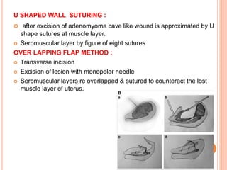 U SHAPED WALL SUTURING :
 after excision of adenomyoma cave like wound is approximated by U
shape sutures at muscle layer.
 Seromuscular layer by figure of eight sutures
OVER LAPPING FLAP METHOD :
 Transverse incision
 Excision of lesion with monopolar needle
 Seromuscular layers re overlapped & sutured to counteract the lost
muscle layer of uterus.
 