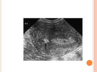 Classification for adenomyosis based on MRI
uterine JZ:
 (i) simple JZ hyperplasia (zone thickness 8 mm but
<12 mm on T2-...