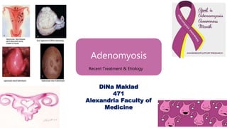 Adenomyosis
Recent Treatment & Etiology
DiNa Maklad
471
Alexandria Faculty of
Medicine
 