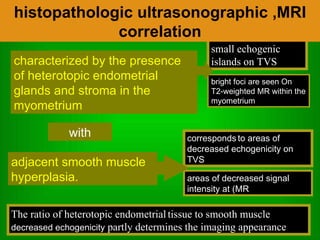 areas of decreased signal intensity at (MR bright foci are seen On T2-weighted MR within the myometrium  characterized by the presence of heterotopic endometrial glands and stroma in the myometrium corresponds   to areas of decreased echogenicity on TVS with small echogenic   islands on TVS The ratio of heterotopic endometrial   tissue to smooth muscle  decreased echogenicity  partly determines the imaging appearance   adjacent smooth muscle hyperplasia. histopathologic ultrasonographic ,MRI correlation 