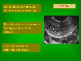 normal myometrium ( M ), homogeneous echotexture The subendometrial haloas a thin hypoechoic band (arrows).  The endometrium is uniformly echogenic NORMAL 