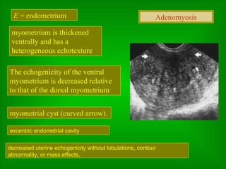 E  = endometrium myometrium is thickened ventrally and has a heterogeneous echotexture  myometrial cyst (curved arrow).  The echogenicity of the ventral myometrium is decreased relative to that of the dorsal myometrium decreased uterine echogenicity without lobulations, contour abnormality, or mass effects,  excentric endometrial cavity Adenomyosis 