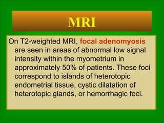 On T2-weighted MRI,  focal adenomyosis  are seen in areas of abnormal low signal intensity within the myometrium in approximately 50% of patients. These foci correspond to islands of heterotopic endometrial tissue, cystic dilatation of heterotopic glands, or hemorrhagic foci.  MRI 
