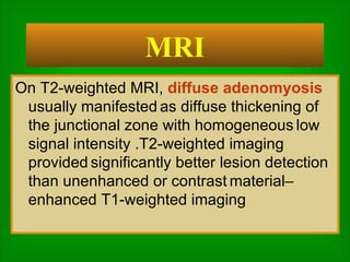 On T2-weighted MRI,  diffuse adenomyosis  usually manifested   as diffuse thickening of the junctional zone with homogeneous   low signal intensity .T2-weighted imaging provided   significantly better lesion detection than unenhanced or contrast   material–enhanced T1-weighted imaging  MRI 