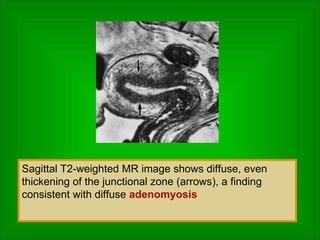 Sagittal T2-weighted MR image shows diffuse, even thickening of the junctional zone (arrows), a finding consistent with diffuse  adenomyosis 