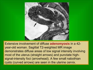 Extensive involvement of diffuse  adenomyosis  in a 42-year-old woman. Sagittal T2-weighted MR image demonstrates diffuse areas of low signal intensity involving most of the uterus (straight arrows) and punctate high-signal-intensity foci (arrowhead). A few small nabothian cysts (curved arrows) are seen in the uterine cervix.  