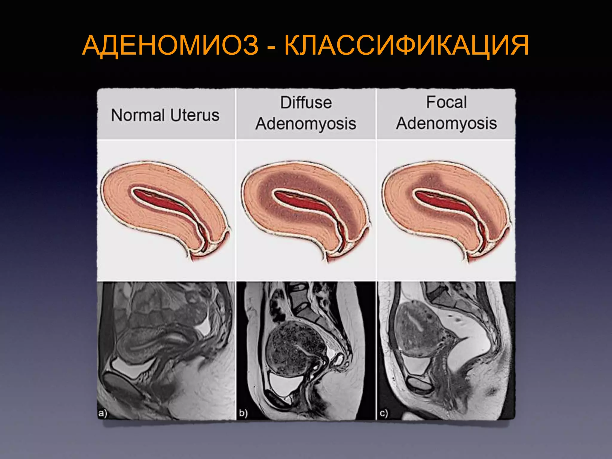 Adenomyosis for gynecologist 2017 | PPTX